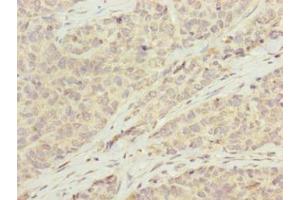 Immunohistochemistry of paraffin-embedded human ovarian cancer using ABIN7145848 at dilution of 1:100 (KCTD19 anticorps  (AA 490-751))