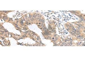 Immunohistochemistry of paraffin-embedded Human colorectal cancer tissue using MIA Polyclonal Antibody at dilution of 1:100(x200) (MIA anticorps)