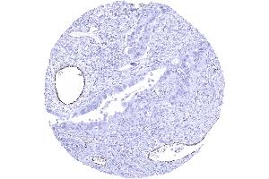 Ovary Serous high grade carcinoma showing distinct endothelial vWF staining in a subset of intratumoral vessels
