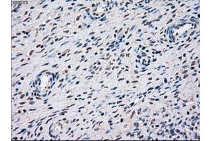 Immunohistochemical staining of paraffin-embedded Adenocarcinoma of breast tissue using anti-STK3 mouse monoclonal antibody. (STK3 anticorps)