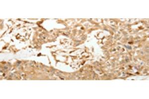 Immunohistochemistry of paraffin-embedded Human esophagus cancer tissue using VMA21 Polyclonal Antibody at dilution of 1:150(x200) (VMA21 anticorps)