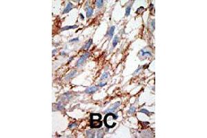 Formalin-fixed and paraffin-embedded human cancer tissue reacted with ISG15 polyclonal antibody  , which was peroxidase-conjugated to the secondary antibody, followed by DAB staining. (ISG15 anticorps  (N-Term))