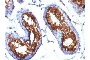 Formalin-fixed, paraffin-embedded human Testicular Carcinoma stained with CD99 Monoclonal Antibody (MIC2/877). (CD99 anticorps)