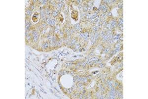 Immunohistochemistry of paraffin-embedded human colon carcinoma using PSG1 antibody at dilution of 1:100 (40x lens). (PSG1 anticorps)