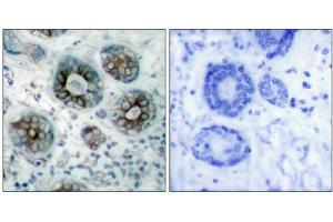 Immunohistochemical analysis of paraffin-embedded human breast carcinoma tissue using GAP43(Ab-41) Antibody(left) or the same antibody preincubated with blocking peptide(right). (GAP43 anticorps)