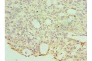 Immunohistochemistry of paraffin-embedded human endommetrial cancer using ABIN7155970 at dilution of 1:100 (HYAL1 anticorps  (AA 136-435))