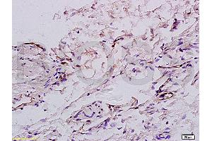 Formalin-fixed and paraffin embedded:human colon carcinoma labeled with Anti-factor VIII(FVIII) (human) Polyclonal Antibody (ABIN728000), Unconjugated at 1:200, followed by conjugation to the secondary antibody and DAB staining