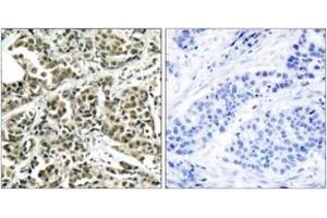 Immunohistochemistry analysis of paraffin-embedded human breast carcinoma tissue, using BRCA1 (Ab-1524) Antibody. (BRCA1 anticorps  (AA 1491-1540))