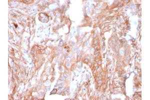 Formalin-fixed, paraffin-embedded human Colon Carcinoma stained with CD73 Mouse Monoclonal Antibody (NT5E/2503).