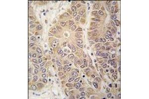 Formalin-fixed and paraffin-embedded human hepatocarcinoma tissue reacted with HARS antibody (N-term), which was peroxidase-conjugated to the secondary antibody, followed by DAB staining. (HARS1/Jo-1 anticorps  (N-Term))