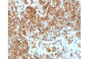 IHC testing of CD45RB antibody and FFPE human lymphoma (PTPRC/1132). (CD45RB anticorps)