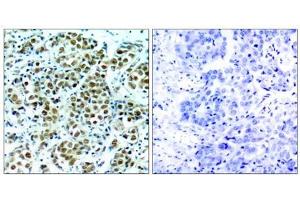 Immunohistochemical analysis of paraffin-embedded human breast carcinoma tissue, using p90RSK (phospho-Thr348) antibody (E011105). (RPS6KA3 anticorps  (pThr348))