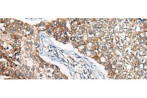 Immunohistochemistry of paraffin-embedded Human lung cancer tissue using BBS12 Polyclonal Antibody at dilution of 1:50(x200) (BBS12 anticorps)