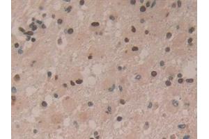 Detection of HDGF in Human Glioma Tissue using Polyclonal Antibody to Hepatoma Derived Growth Factor (HDGF) (HDGF anticorps  (AA 10-240))