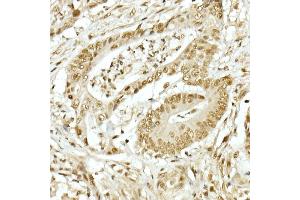 Immunohistochemistry of paraffin-embedded human colon carcinoma using TOPBP1 Rabbit pAb (ABIN6129493, ABIN6149398, ABIN6149401 and ABIN6221465) at dilution of 1:50 (40x lens). (TOPBP1 anticorps  (AA 1253-1522))