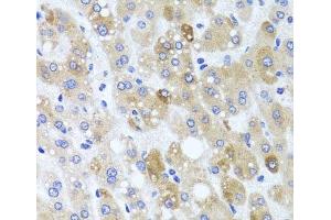 Immunohistochemistry of paraffin-embedded Human liver damage using ATP7A Polyclonal Antibody at dilution of 1:100 (40x lens). (ATP7A anticorps)