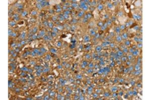 The image on the left is immunohistochemistry of paraffin-embedded Human breast cancer tissue using ABIN7130083(LGALS3BP Antibody) at dilution 1/25, on the right is treated with fusion protein. (LGALS3BP anticorps)