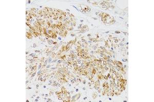 Immunohistochemistry of paraffin-embedded human prostate cancer using MYO5A antibody (ABIN6003562) at dilution of 1/100 (40x lens).