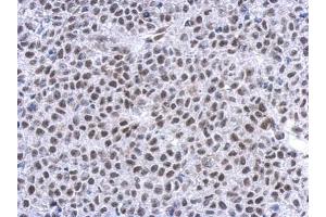 IHC-P Image Immunohistochemical analysis of paraffin-embedded Hela xenograft, using Glucocorticoid receptor, antibody at 1:500 dilution. (Glucocorticoid Receptor anticorps  (N-Term))