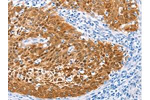 The image on the left is immunohistochemistry of paraffin-embedded Human cervical cancer tissue using ABIN7129916(IRF6 Antibody) at dilution 1/50, on the right is treated with fusion protein. (IRF6 anticorps)