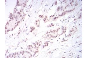 Immunohistochemical analysis of paraffin-embedded colon cancer tissues using DNMT3B mouse mAb with DAB staining. (DNMT3B anticorps  (AA 1-150))