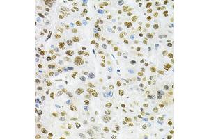 Immunohistochemistry of paraffin-embedded human liver cancer using B/B/SM Antibody  at dilution of 1:200 (40x lens). (SMARCE1 anticorps  (AA 1-411))