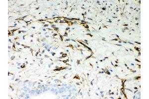 Anti- Vimentin Picoband antibody, IHC(P) IHC(P): Human Mammary Cancer Tissue (Vimentin anticorps  (C-Term))