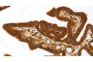 Immunohistochemistry of paraffin-embedded Human thyroid cancer using TP53I11 Polyclonal Antibody at dilution of 1:40 (TP53I11 anticorps)