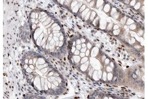 ABIN6267322 at 1/200 staining human colon carcinoma tissue sections by IHC-P. (EIF4E anticorps  (pSer209))