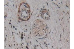 Detection of AATK in Human Pancreatic cancer Tissue using Polyclonal Antibody to Apoptosis Associated Tyrosine Kinase (AATK)