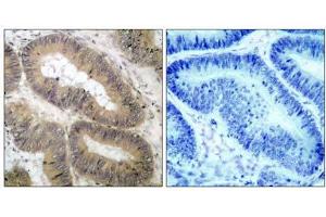 Immunohistochemical analysis of paraffin- embedded human colon carcinoma tissue, using IKKα (phospho-Thr23) antibody (E011129). (IKK alpha anticorps  (pThr23))