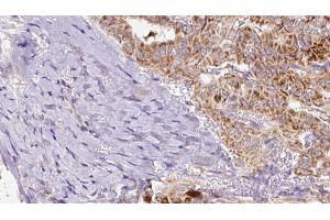 ABIN6267082 at 1/100 staining Human thyroid cancer tissue by IHC-P.