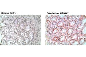 Immunohistochemistry analysis of formalin-fixed, paraffin-embedded human colon tumor tissue stained with Fas polyclonal antibody,  at 10 μg/mL. (FAS anticorps)