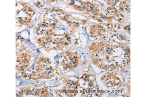 Immunohistochemistry of Human thyroid cancer using CTSL Polyclonal Antibody at dilution of 1:40 (Cathepsin L anticorps)