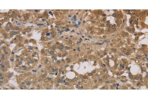 Immunohistochemistry of paraffin-embedded Human thyroid cancer tissue using DEGS1 Polyclonal Antibody at dilution 1:30 (DEGS1 anticorps)