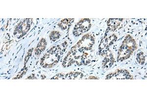 Immunohistochemistry of paraffin-embedded Human esophagus cancer tissue using GMFB Polyclonal Antibody at dilution of 1:25(x200) (GMFB anticorps)