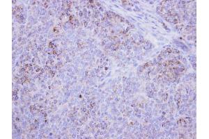IHC-P Image Immunohistochemical analysis of paraffin-embedded DLD-1 xenograft , using HSD17B4, antibody at 1:500 dilution. (HSD17B4 anticorps)