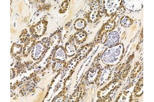 ABIN7096023 and ABIN7100085 at 1/100 staining human ovarian cancer by IHC-P. (MAPK1IP1L anticorps)