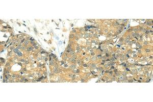 Immunohistochemistry of paraffin-embedded Human breast cancer using TRIM10 Polyclonal Antibody at dilution of 1/35