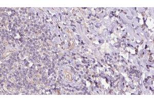 ABIN6273158 at 1/100 staining Human lymph cancer tissue by IHC-P.