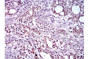 Immunohistochemical analysis of paraffin-embedded cervical cancer tissues using KLF1 mouse mAb with DAB staining.