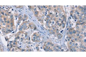 Immunohistochemistry of paraffin-embedded Human breast cancer using KCNQ5 Polyclonal Antibody at dilution of 1:30 (KCNQ5 anticorps)