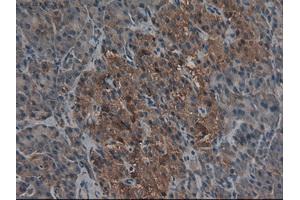 Immunohistochemical staining of paraffin-embedded Carcinoma of kidney using anti-CPA1 (ABIN2452540) mouse monoclonal antibody. (CPA1 anticorps  (AA 1-419))