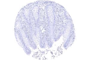 Complete absence of papp A immunostaining in epithelial and stromal cells of the appendix mucosa