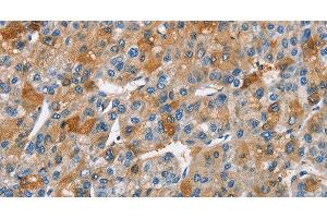 Immunohistochemistry of paraffin-embedded Human liver cancer using BCL10 Polyclonal Antibody at dilution of 1:40 (BCL10 anticorps)