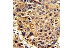 Formalin-fixed and paraffin-embedded human hepatocarcinoma reacted with SPCS3 Antibody (C-term), which was peroxidase-conjugated to the secondary antibody, followed by DAB staining.