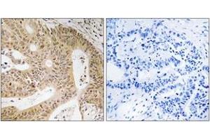 Immunohistochemistry analysis of paraffin-embedded human colon carcinoma tissue, using DAP Antibody. (DAP anticorps  (AA 11-60))