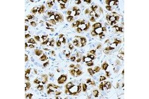 Immunohistochemical analysis of PRG2 staining in human gastric cancer formalin fixed paraffin embedded tissue section. (PRG2 anticorps)