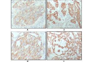 Immunohistochemical analysis of paraffin-embedded human breast carcinoma (A), lung cancer (B) and ovarian cancer tissue (C), showing membrane and cytoplasmic localization with DAB staining using CK8 mouse mAb. (KRT8 anticorps)