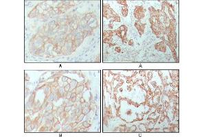 Immunohistochemical analysis of paraffin-embedded human breast carcinoma (A), lung cancer (B) and ovarian cancer tissue (C), showing membrane and cytoplasmic localization with DAB staining using CK8 mouse mAb.